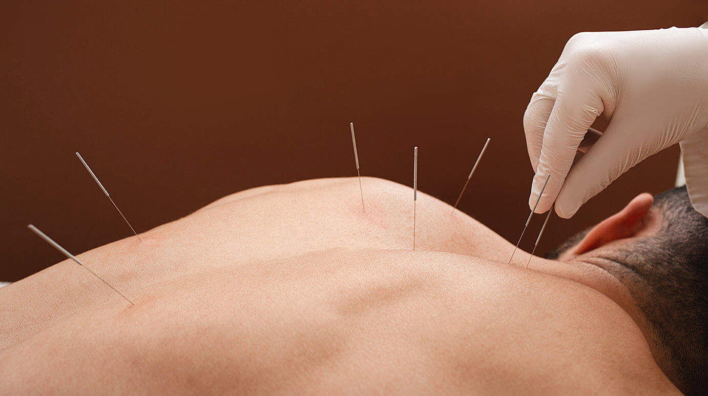 benefits of acupuncture benefits of acupuncture