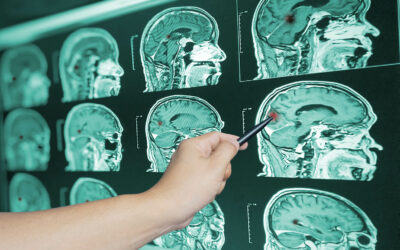 Chiropractor After Concussion: How Chiropractors Can Help Treat Mild Traumatic Brain Injuries